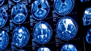 Traumatic brain injury (TBI) symptoms after a car accident may appear immediately — or hours, days, or even weeks later. Common warning signs include headaches, dizziness, confusion, memory issues, nausea, and mood changes. Don’t Ignore These Traumatic Brain Injury Symptoms After a Car Wreck