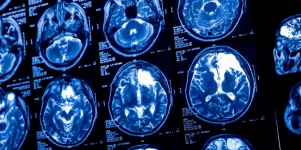 Don’t Ignore These Traumatic Brain Injury Symptoms After a Car Wreck