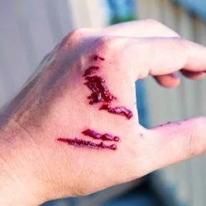 Dog bite injuries can be serious and lead to infection, scarring, or other impairments. Orangeburg Dog Bite Lawyer